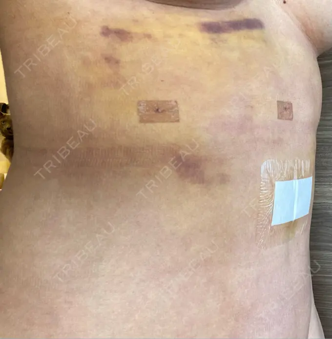 脂肪吸引（二の腕） / 脂肪吸引（お腹） / 豊胸（脂肪注入） / 脂肪吸引（肩） Casa de GRACIA GINZA 【カーサデグラシアギンザ】 DAY 189 メイン用