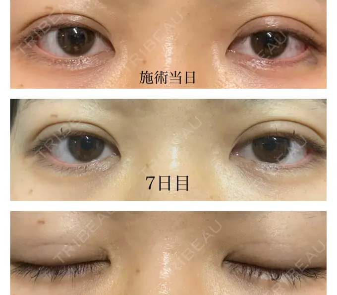 二重埋没 水の森美容クリニック 東京銀座院 DAY 7 メイン用