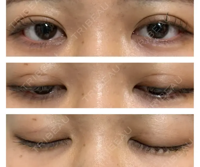 二重埋没 水の森美容クリニック 東京銀座院 DAY 6 メイン用