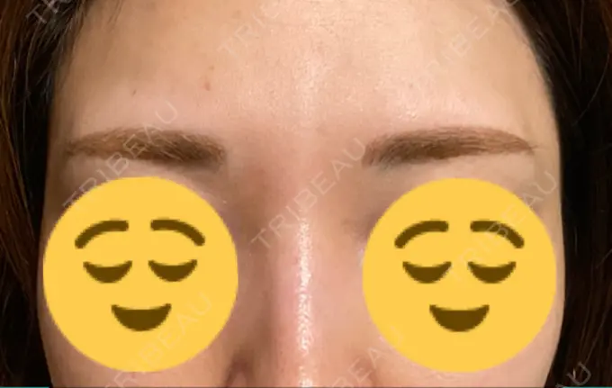 アートメイク（眉） 表参道メディカルクリニック 名古屋院 DAY 86 メイン用