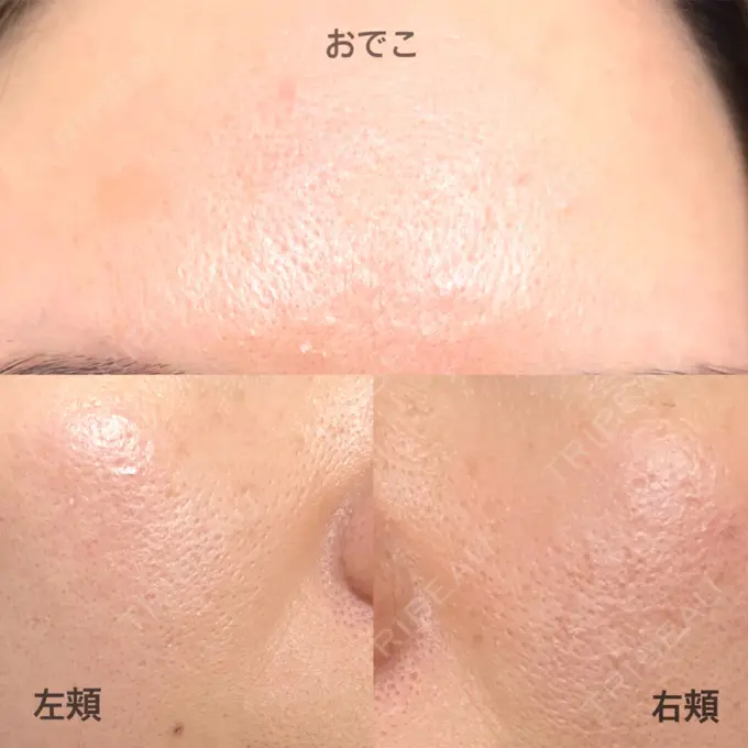 レーザーフェイシャル 石倉クリニック 水戸院 AFTER メイン用