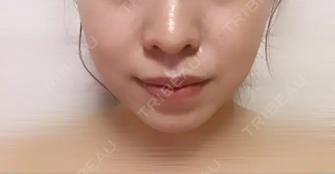 糸リフト / バッカルファット除去 / 脂肪吸引（顔） / ヒアルロン酸注入（あご） / ボトックス（エラ・小顔） RIVER CLINIC（リバークリニック） DAY 17 メイン用