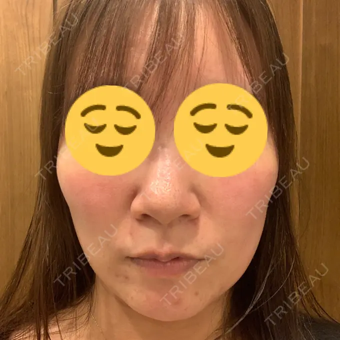 その他（肌） / ルメッカ BIANCA表参道 DAY 4 メイン用