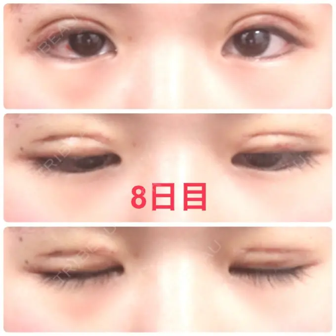二重切開 品川スキンクリニック広島院 DAY 8 メイン用