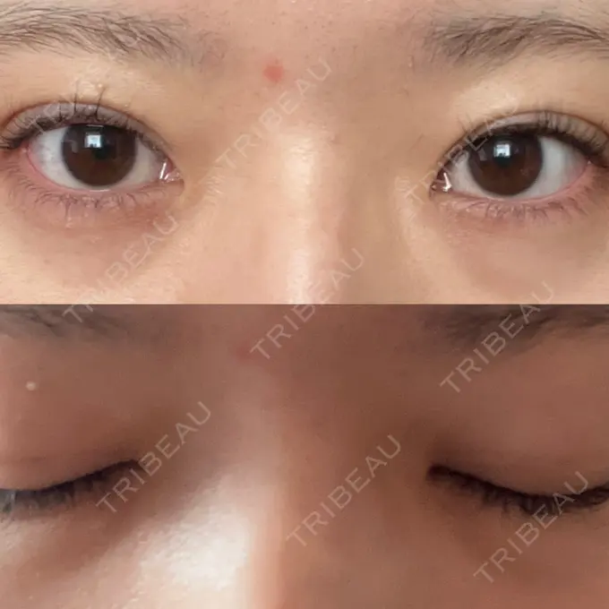 二重埋没 / ハイフ（顔） 日本ウェルネス再生クリニック AFTER メイン用