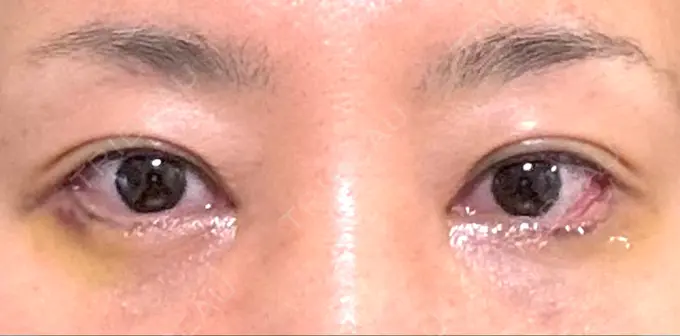 目尻切開 / タレ目形成・グラマラスライン（埋没） / 美容点滴・美容注射（美肌） LOUIS CLINIC 二子玉川院【ルイクリニック】 DAY 4 メイン用