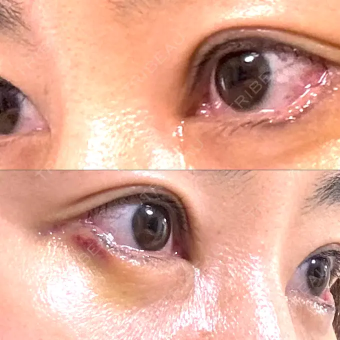 目尻切開 / タレ目形成・グラマラスライン（埋没） / 美容点滴・美容注射（美肌） LOUIS CLINIC 二子玉川院【ルイクリニック】 DAY 4 メイン用