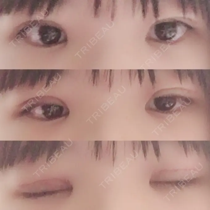 二重切開 / 上まぶたの脂肪取り 聖心美容クリニック 横浜院 DAY 6 メイン用