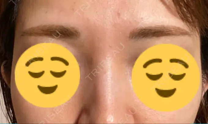 アートメイク（眉） 表参道メディカルクリニック 名古屋院 DAY 90 メイン用