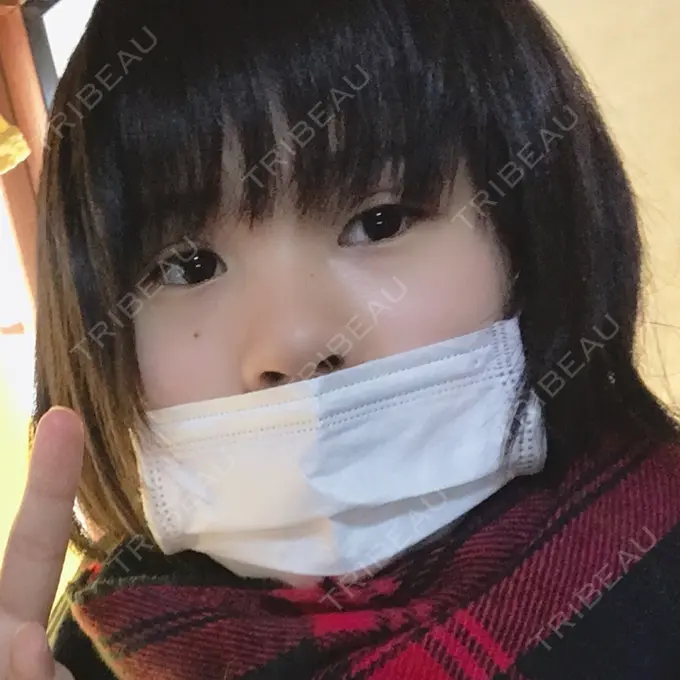 二重埋没 久留米総合美容外科 DAY 3 メイン用