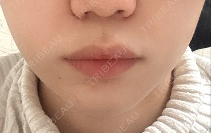 ボトックス（口角） / ボトックス（人中） veary clinic DAY 0 メイン用