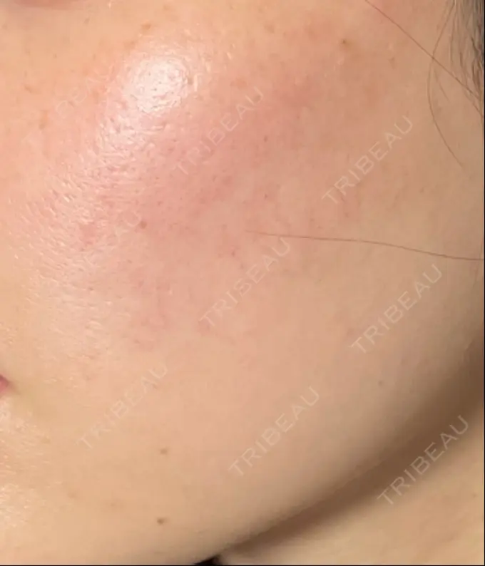 イオン導入 / ルメッカ ルラ美容クリニック 高田馬場院 DAY 8 メイン用