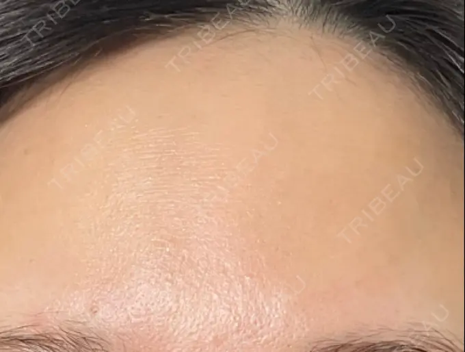 イオン導入 / ルメッカ ルラ美容クリニック 高田馬場院 DAY 8 メイン用