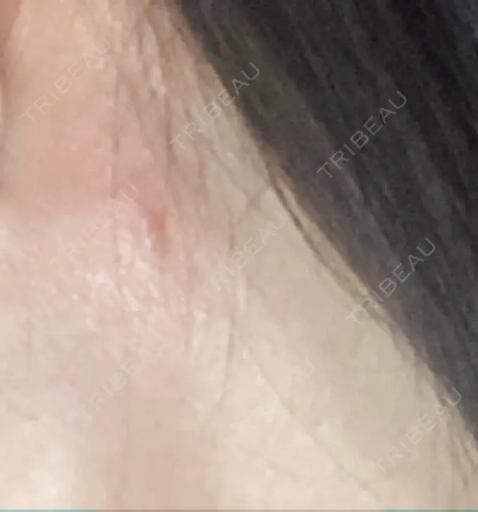 糸リフト / 脂肪吸引（顔） RIVER CLINIC（リバークリニック） DAY 14 メイン用