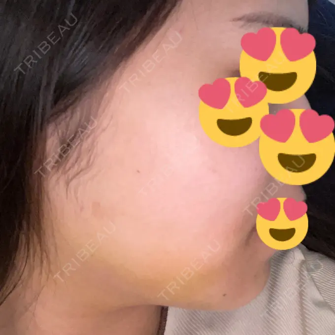 糸リフト / 脂肪吸引（顔） / ボトックス（エラ・小顔） RIVER CLINIC（リバークリニック） DAY 5 メイン用