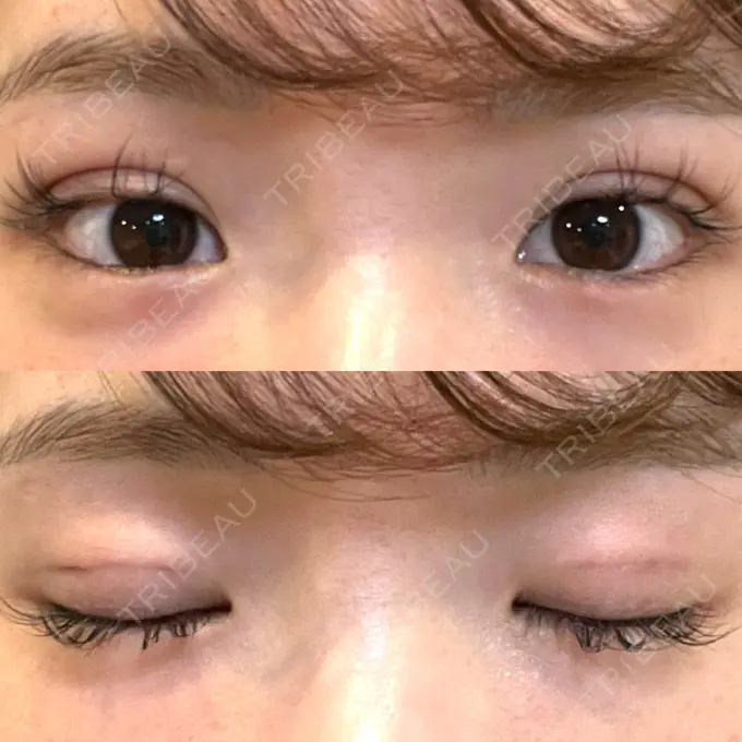 二重埋没 湘南美容クリニック 京都院 DAY 0 メイン用