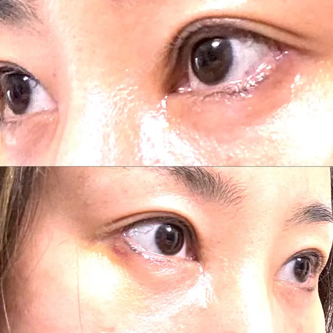 目尻切開 / タレ目形成・グラマラスライン（埋没） / 美容点滴・美容注射（美肌） LOUIS CLINIC 二子玉川院【ルイクリニック】 DAY 7 メイン用