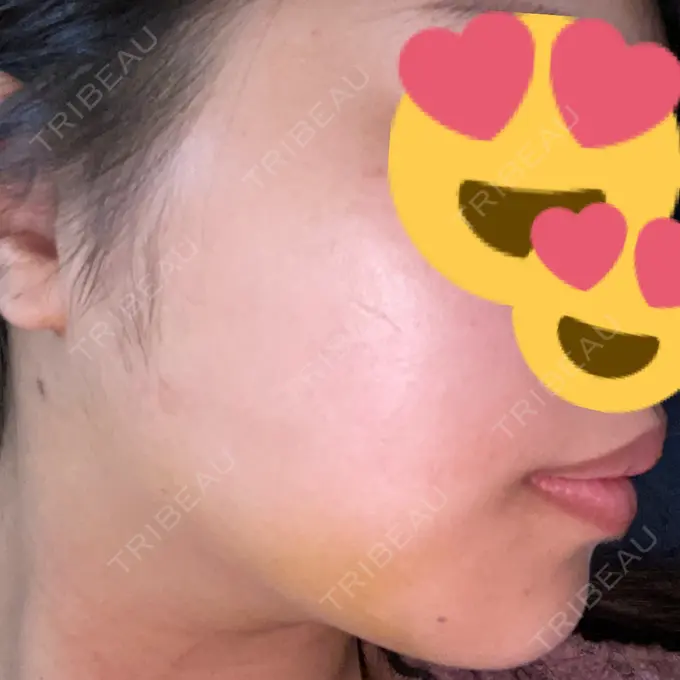 糸リフト / 脂肪吸引（顔） / ボトックス（エラ・小顔） RIVER CLINIC（リバークリニック） DAY 6 メイン用