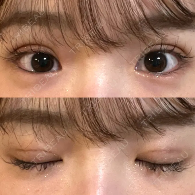 二重埋没 湘南美容クリニック 京都院 DAY 1 メイン用