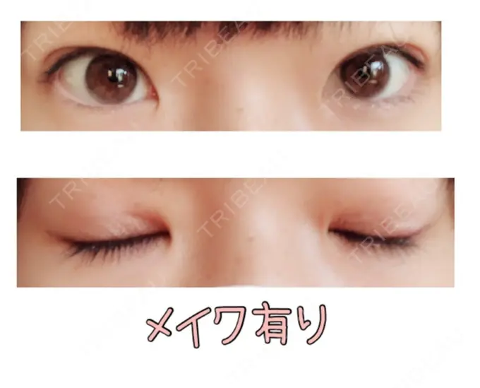 二重埋没 品川スキンクリニック広島院 DAY 10 メイン用