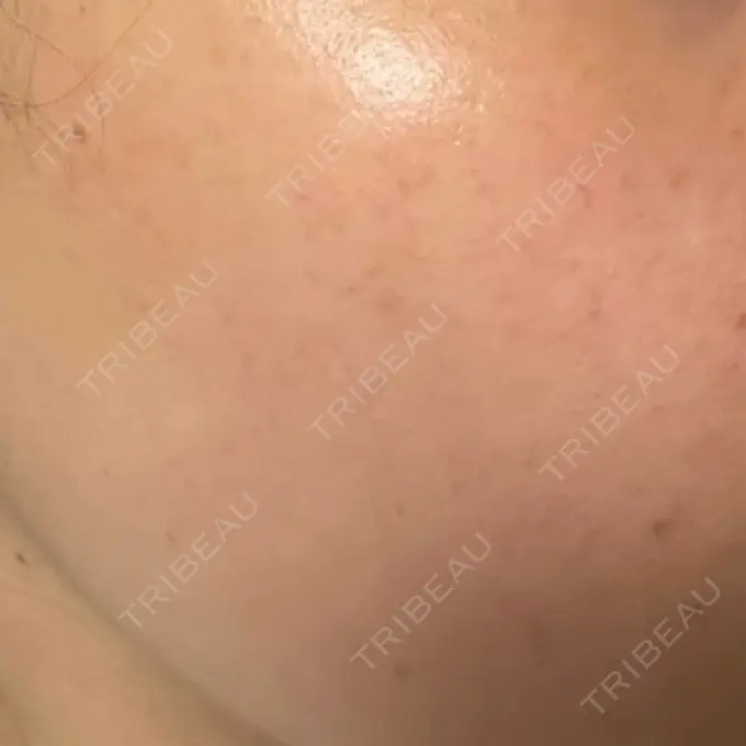 イオン導入 / ルメッカ ルラ美容クリニック 高田馬場院 DAY 9 メイン用