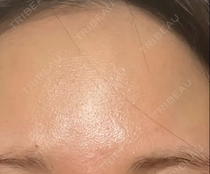 イオン導入 / ルメッカ ルラ美容クリニック 高田馬場院 DAY 9 メイン用