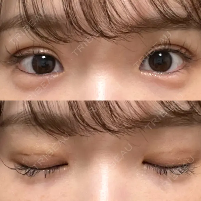 二重埋没 湘南美容クリニック 京都院 DAY 2 メイン用