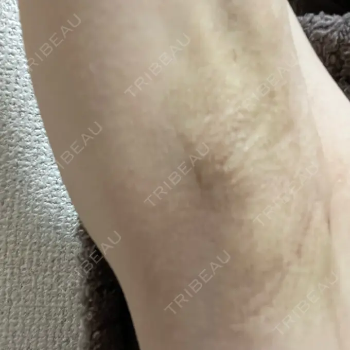 ワキ汗治療（切開） 東京シンデレラ美容外科 池袋院 AFTER メイン用