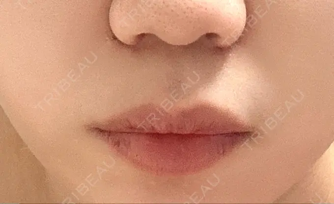 ボトックス（口角） / ボトックス（人中） veary clinic DAY 3 メイン用