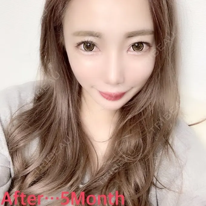 目頭切開 / 糸リフト / あごプロテーゼ / バッカルファット除去 / 目尻切開 / 軟骨移植 / 眉間プロテーゼ / ヒアルロン酸注入（涙袋） / その他（鼻） ミナ美容外科 DAY 150 メイン用