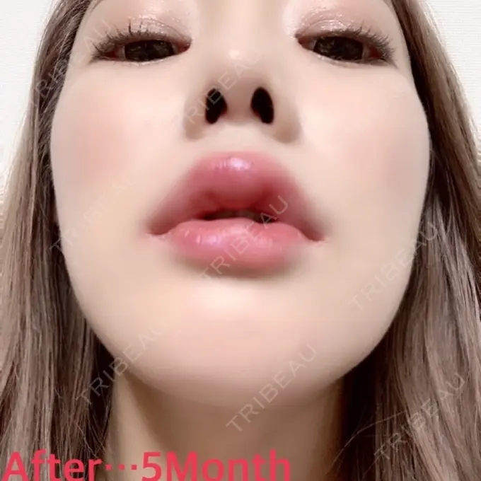 目頭切開 / 糸リフト / あごプロテーゼ / バッカルファット除去 / 目尻切開 / 軟骨移植 / 眉間プロテーゼ / ヒアルロン酸注入（涙袋） / その他（鼻） ミナ美容外科 DAY 150 メイン用