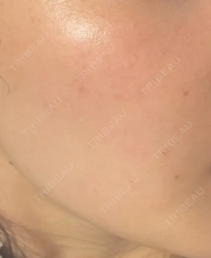 イオン導入 / ルメッカ ルラ美容クリニック 高田馬場院 AFTER メイン用