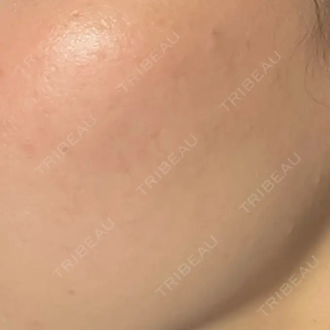 イオン導入 / ルメッカ ルラ美容クリニック 高田馬場院 DAY 11 メイン用