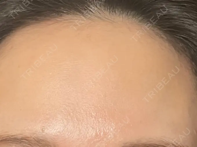 イオン導入 / ルメッカ ルラ美容クリニック 高田馬場院 DAY 11 メイン用