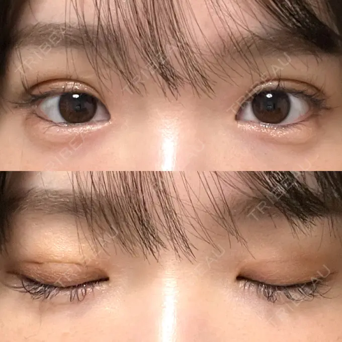 二重埋没 湘南美容クリニック 京都院 DAY 3 メイン用