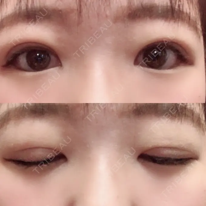 二重埋没 湘南美容クリニック 仙台院 DAY 8 メイン用