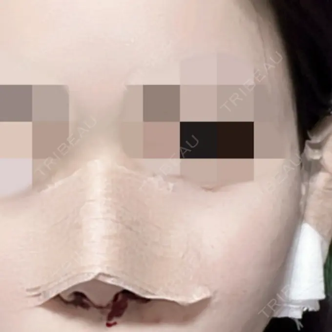 鼻尖形成（切開） / 小鼻縮小（切開） / 軟骨移植 / 鼻孔縁下降 / ヒアルロン酸注入（鼻） ziz CLINIC DAY 0 メイン用