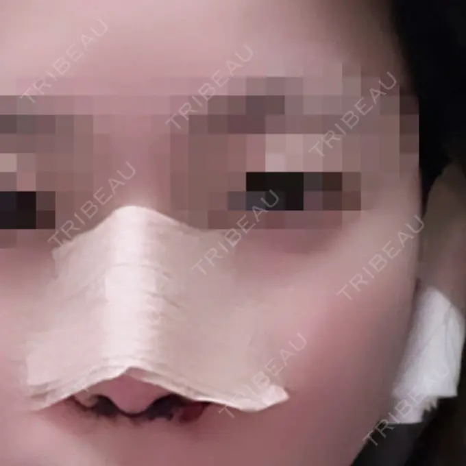 鼻尖形成（切開） / 小鼻縮小（切開） / 軟骨移植 / 鼻孔縁下降 / ヒアルロン酸注入（鼻） ziz CLINIC DAY 1 メイン用