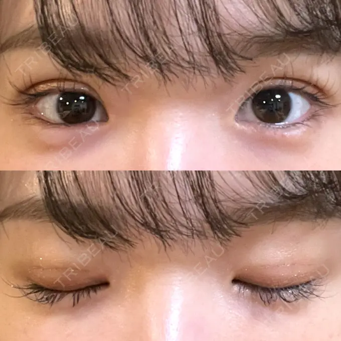 二重埋没 湘南美容クリニック 京都院 DAY 4 メイン用