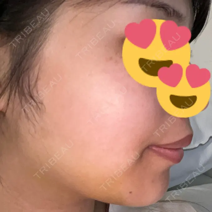 糸リフト / 脂肪吸引（顔） / ボトックス（エラ・小顔） RIVER CLINIC（リバークリニック） DAY 9 メイン用