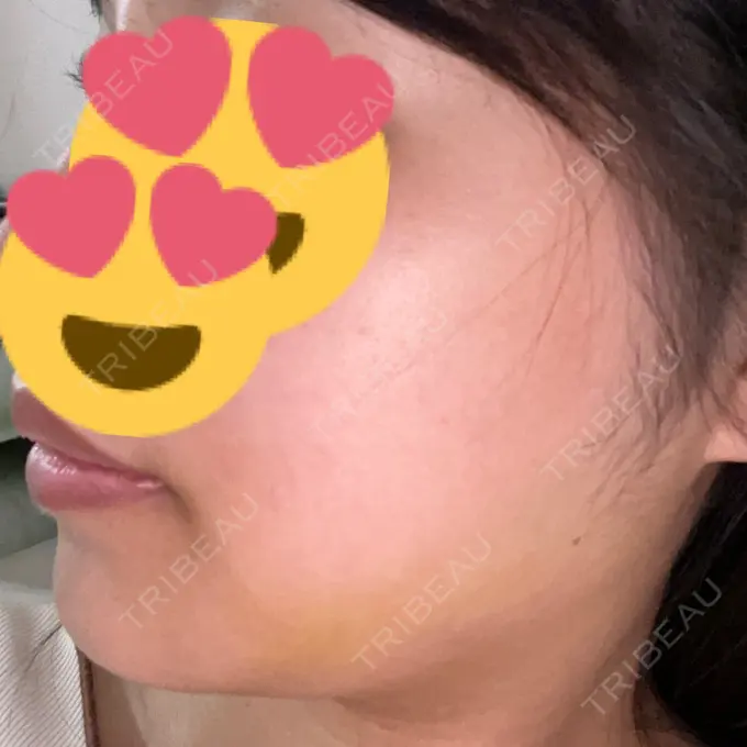 糸リフト / 脂肪吸引（顔） / ボトックス（エラ・小顔） RIVER CLINIC（リバークリニック） DAY 9 メイン用