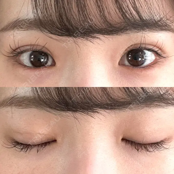 二重埋没 湘南美容クリニック 京都院 DAY 5 メイン用