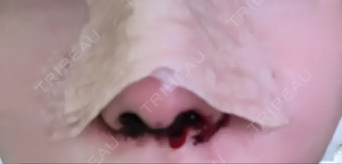 鼻尖形成（切開） / 小鼻縮小（切開） / 軟骨移植 / 鼻孔縁下降 / ヒアルロン酸注入（鼻） ziz CLINIC DAY 2 メイン用