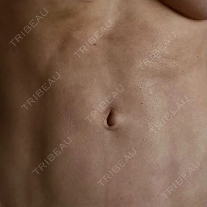 脂肪吸引（二の腕） / 脂肪吸引（お腹） / 豊胸（脂肪注入） / 脂肪吸引（肩） Casa de GRACIA GINZA 【カーサデグラシアギンザ】 DAY 199 メイン用