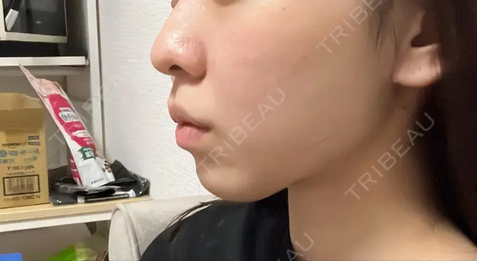 糸リフト / バッカルファット除去 / 脂肪吸引（顔） / ヒアルロン酸注入（あご） / ボトックス（エラ・小顔） RIVER CLINIC（リバークリニック） DAY 25 メイン用