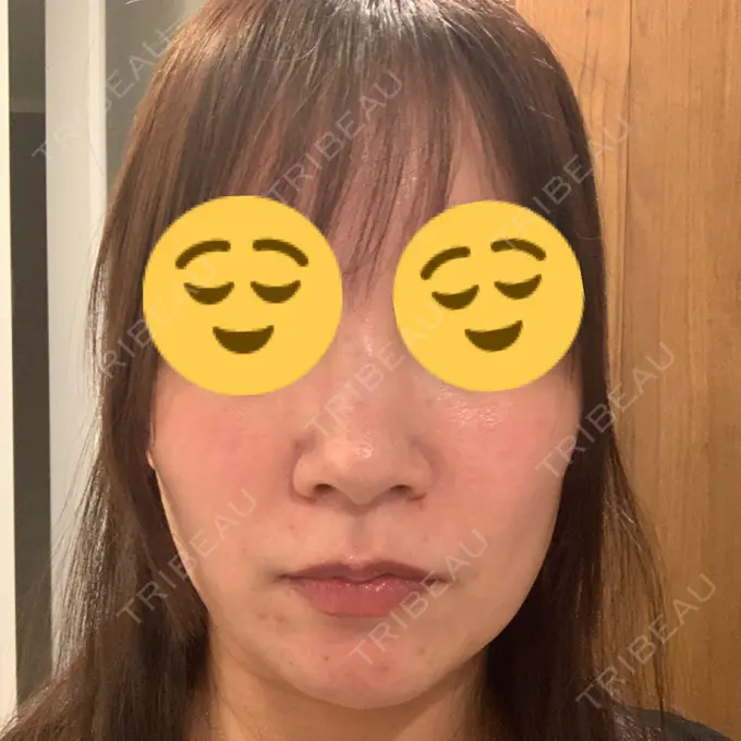 その他（肌） / ルメッカ BIANCA表参道 AFTER メイン用