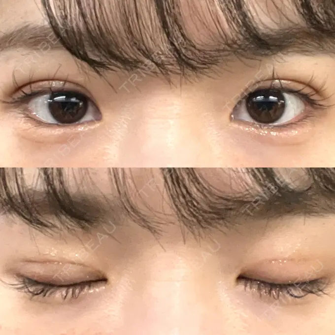 二重埋没 湘南美容クリニック 京都院 DAY 6 メイン用