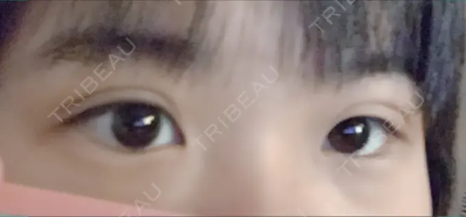 二重埋没 久留米総合美容外科 DAY 5 メイン用