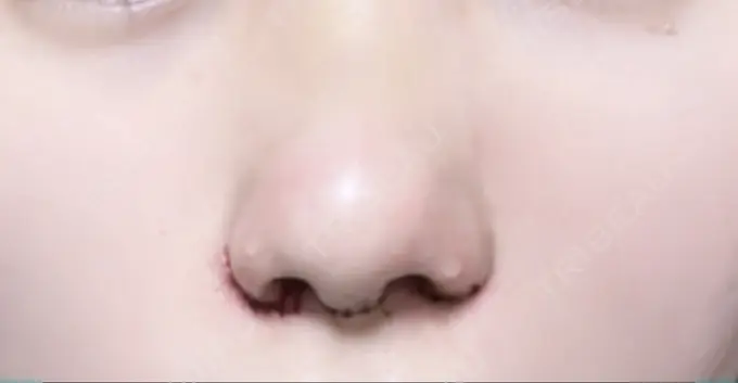 鼻尖形成（切開） / 小鼻縮小（切開） / 軟骨移植 / 鼻孔縁下降 / ヒアルロン酸注入（鼻） ziz CLINIC DAY 3 メイン用