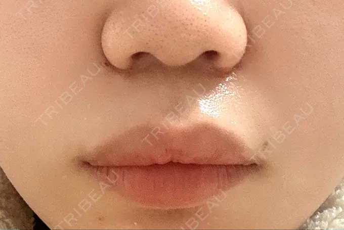 ボトックス（口角） / ボトックス（人中） veary clinic AFTER メイン用